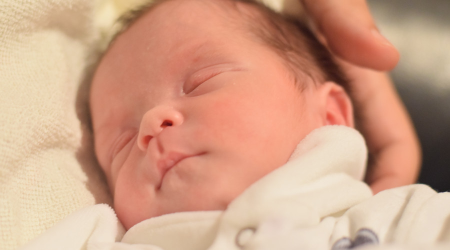 婴儿水肿的症状,婴儿水肿的原因