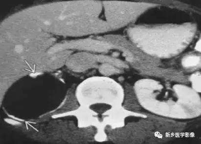 腹部平片能看到结石吗,腹部高密度结节影是什么