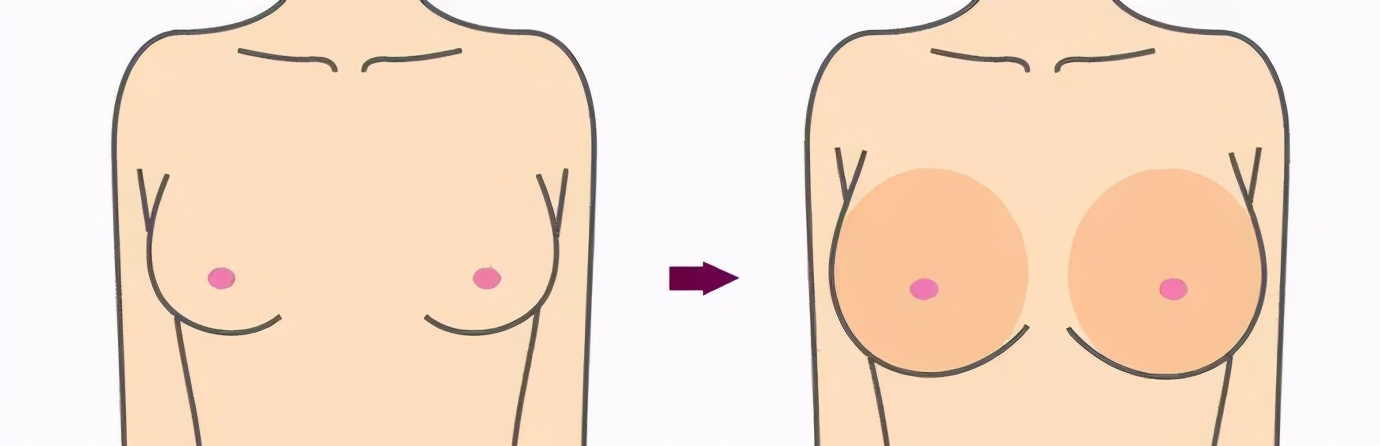 自体脂肪和假体隆胸的优缺点,假体隆胸与自体脂肪的区别