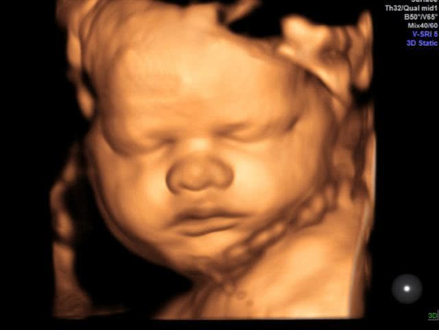 大排畸太胖胎儿显示不清晰咋办,孕妈检查nt说腹壁太厚
