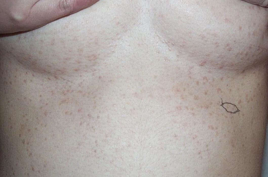 你以为的脂肪粒其实是肿瘤,脂肪粒会转变成癌吗