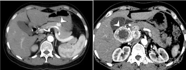 胰腺尾部肿块怎么判断,胰腺精准治疗
