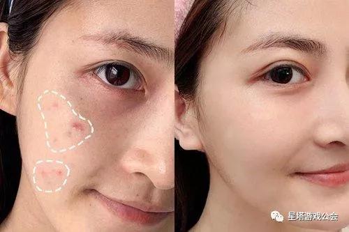 屈臣氏必买的乳膏,屈臣氏好物祛痘神器