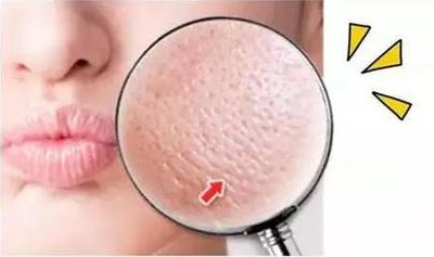 闭口黑头粉刺怎么才能根除,有效解决黑头闭口粉刺的问题