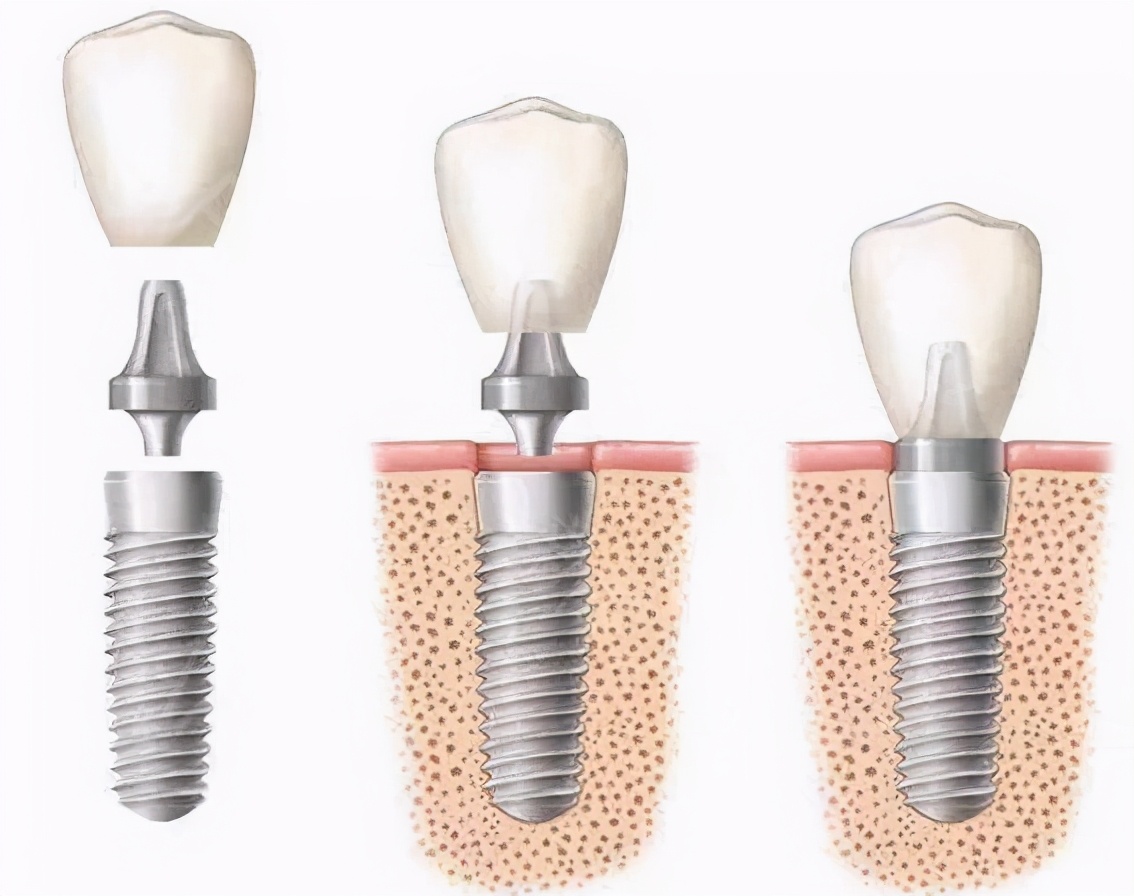 种植牙那么贵为啥不整治,一个牙医的良心忠告种植牙