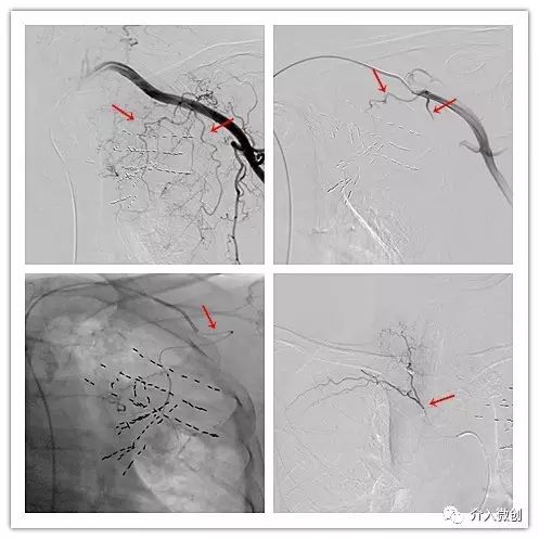 肺转移瘤消融能达到根治效果吗,肺转移瘤中医治疗