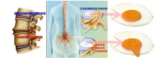 腰椎间盘突出症误区,腰椎间盘突出症的十个注意事项