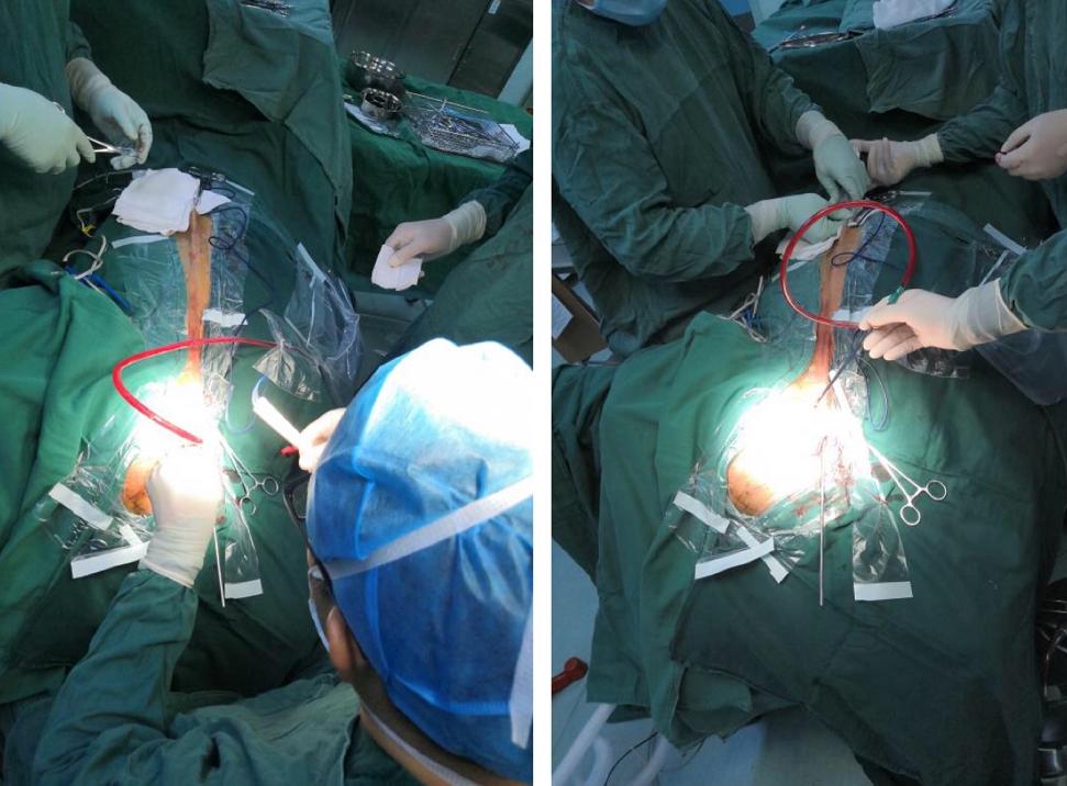 泉州：突破！永春县总医院成功开展新技术