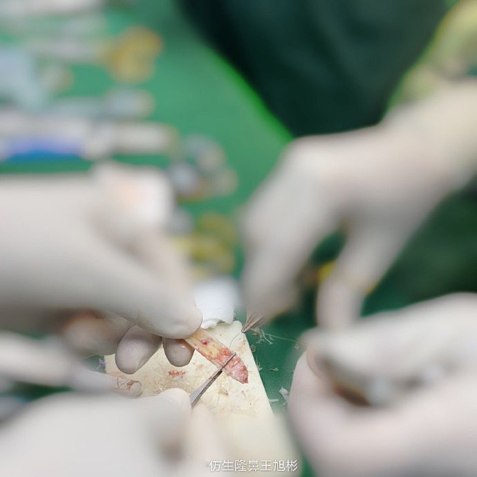 骨粉注射隆鼻皮肤变薄怎么办,线雕隆鼻会引起鼻挛缩吗