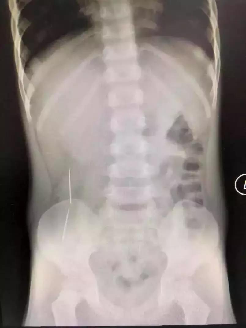 小孩误吃碎玻璃最坏后果,儿童误吞玻璃死亡