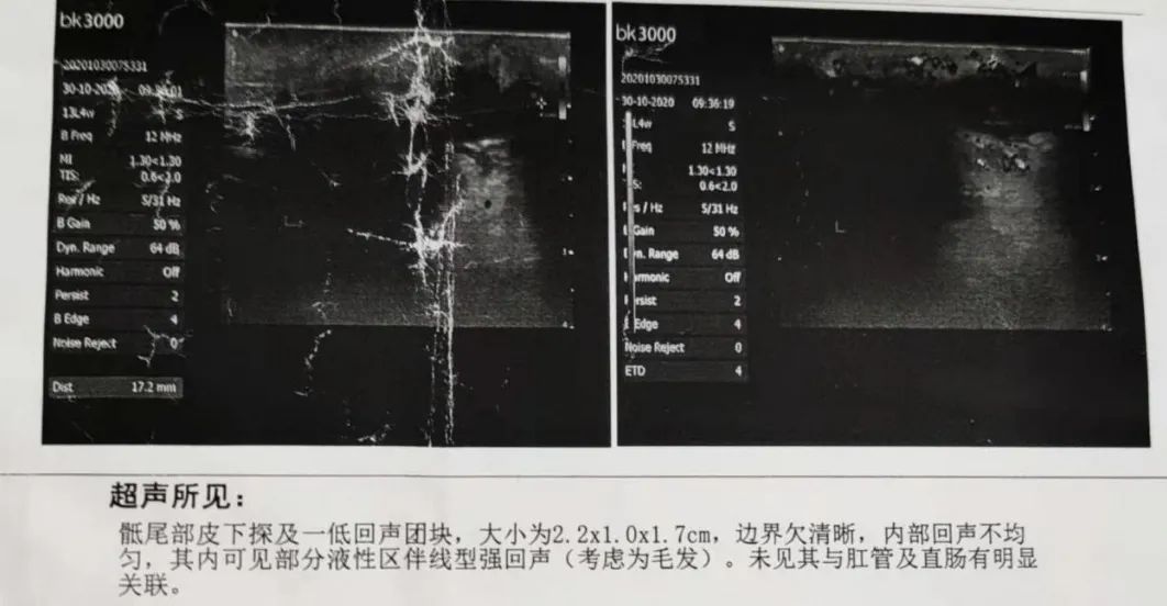 尾骨周围藏毛窦怎么治疗,藏毛窦专家问诊