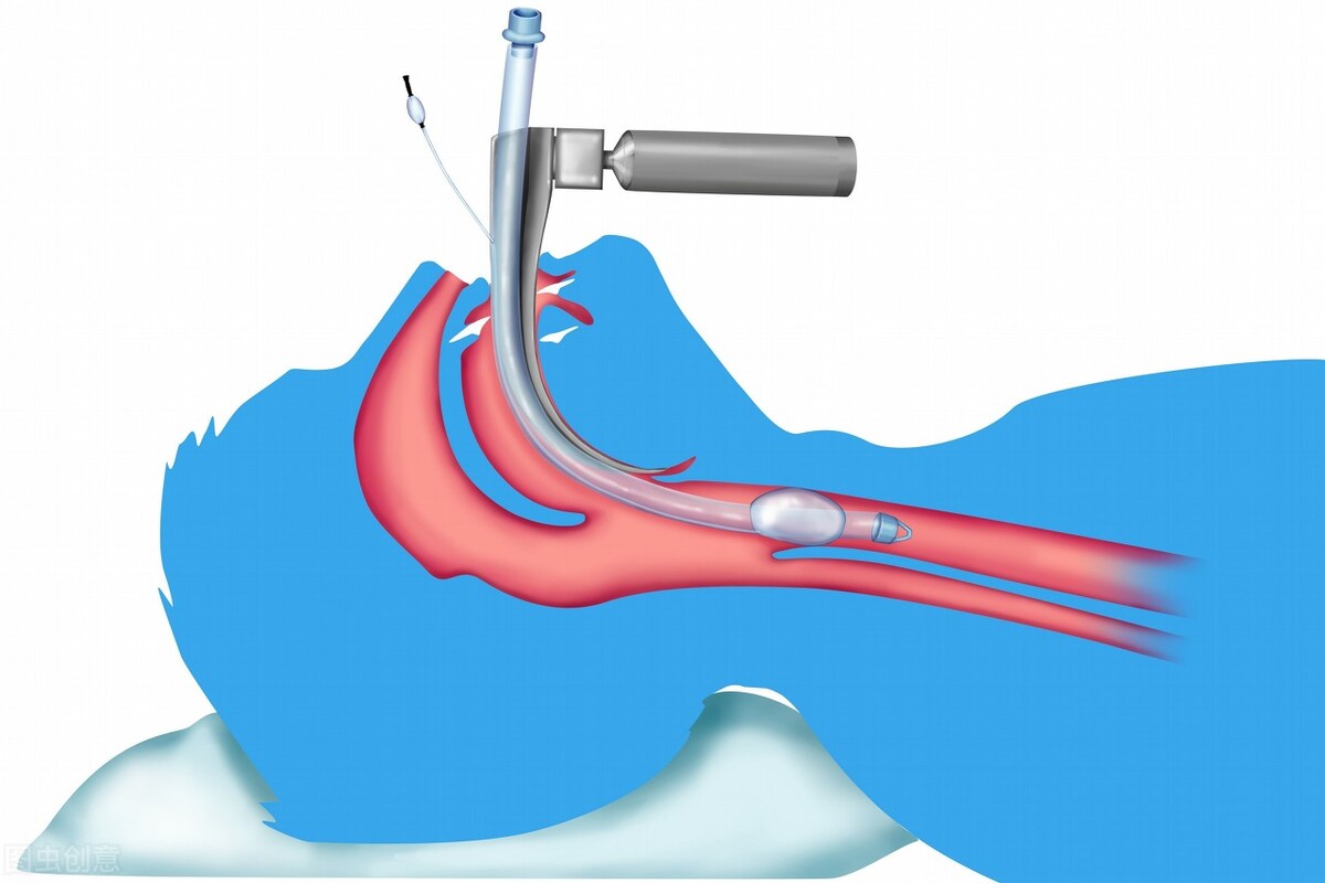 气管插管导致气管瘘，患者去世后，家属索赔47万丨医法汇