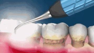 牙齿特别黄洗牙都没用怎么美白,什么牙膏美白牙齿去黄最好