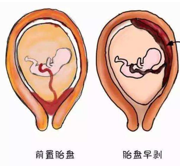 怎样解决孕期出血,孕期出血如何清理外阴