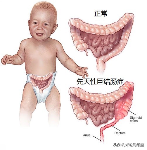 便秘是因为大肠缺水吗,宝宝便秘是因为油少了吗