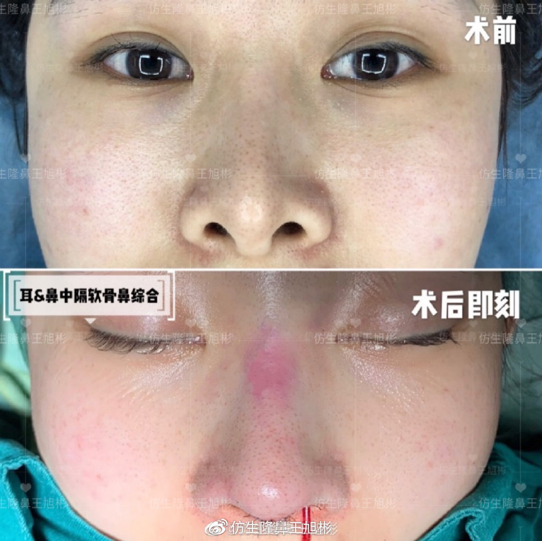 假体隆鼻耳软骨垫鼻尖图片,l型假体耳软骨隆鼻图片