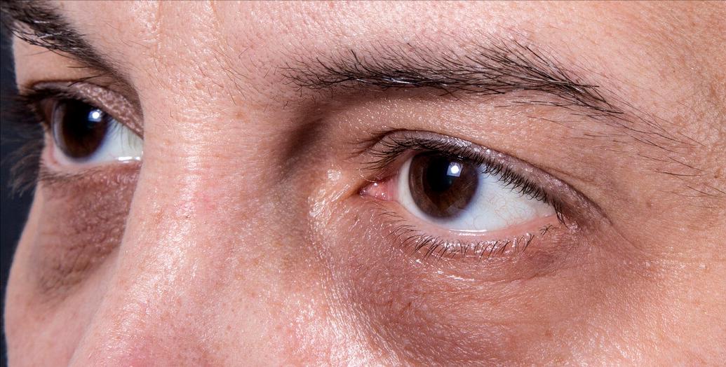 治疗黑眼圈最有效的产品,prp治疗黑眼圈需要做几次费用多少