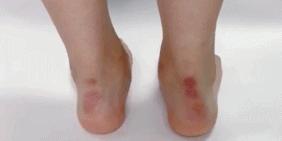 长时间运动起水泡？预防水泡，这个神器适合你