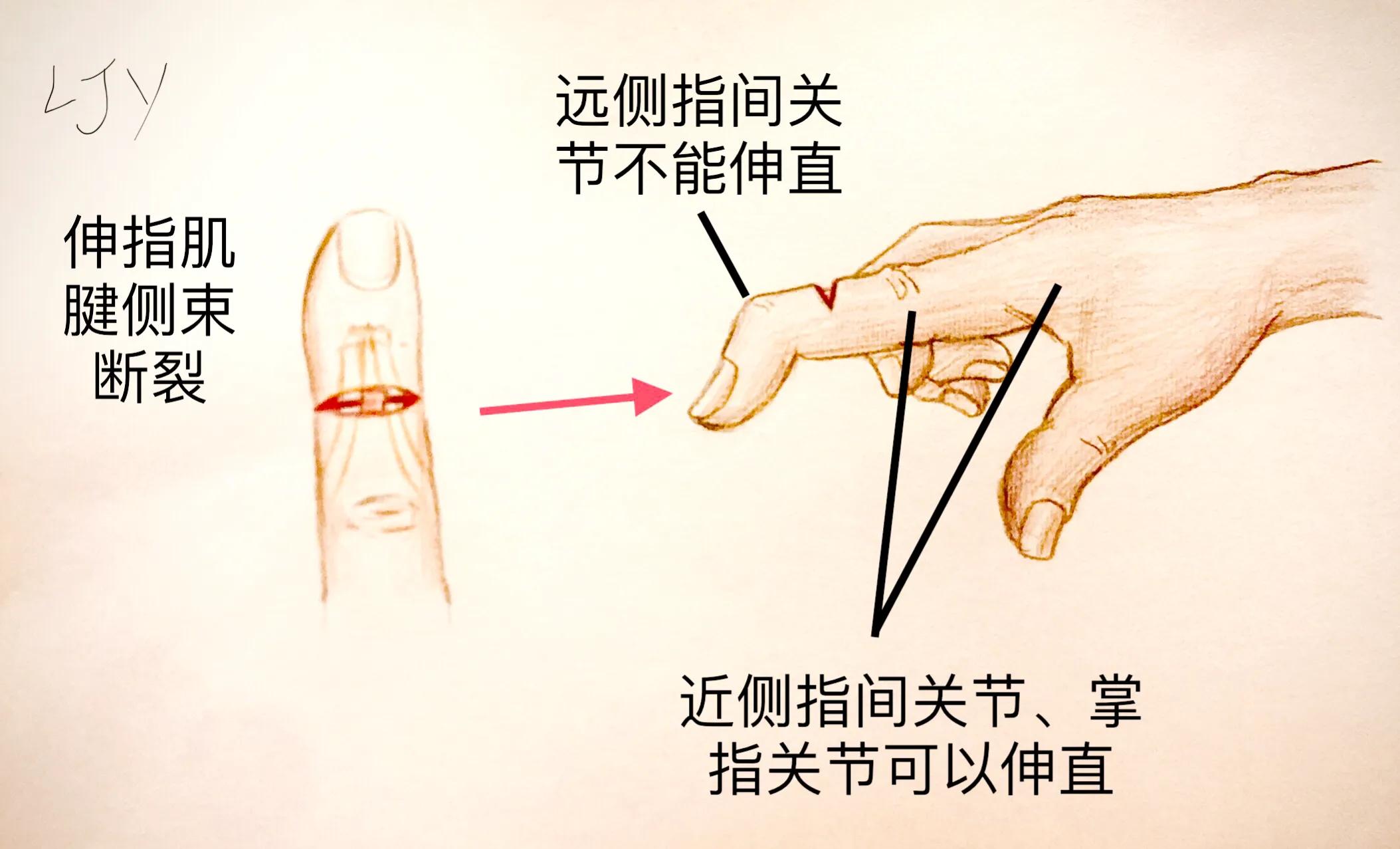 手被割伤如何处理,手被割伤了较深要如何处理