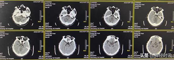 高血压小脑出血治愈率多大,高血压导致小脑出血