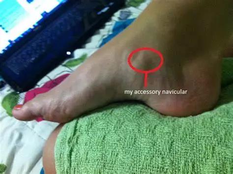 副舟骨疼痛是什么原因引起,副舟骨突出明显是什么原因