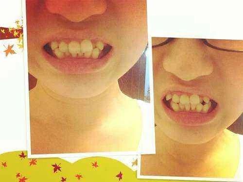 矫正牙齿为什么牙齿有牙缝了,12岁儿童门牙中间有缝隙怎么矫正