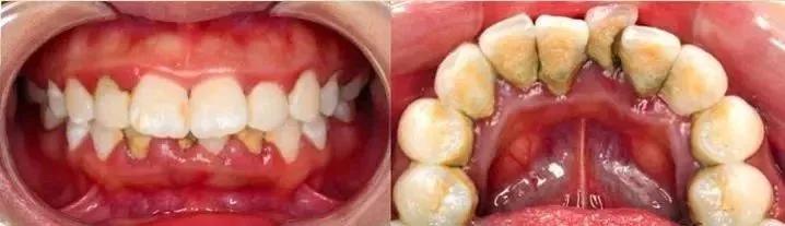 刷牙草草结束，不认真刷，最后可能就会变成这样子