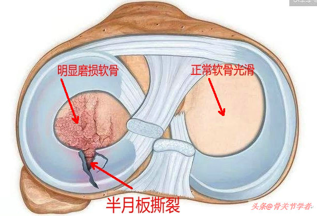 磁共振怎么看半月板损伤程度,磁共振半月板损伤1级是什么