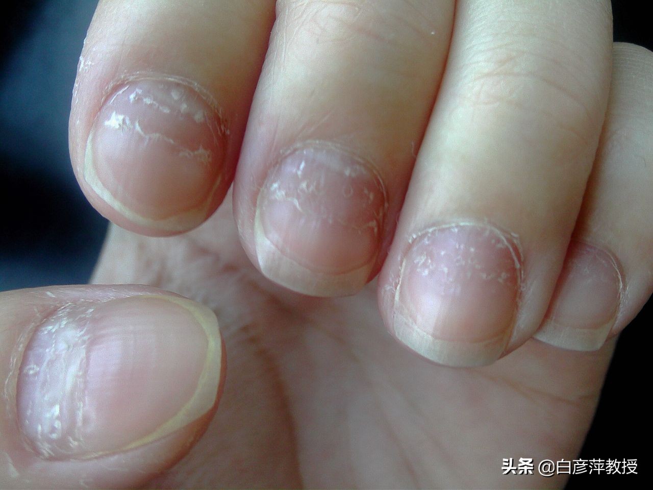 灰指甲是灰色的吗？灰指甲真的会传染吗？皮肤科医生告诉你