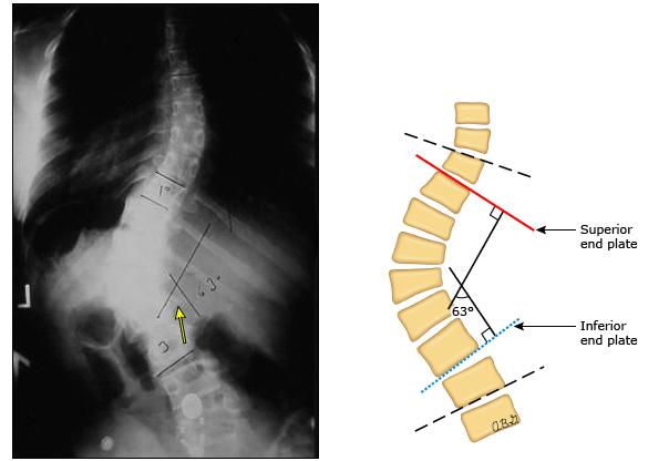 轻度脊柱侧弯医生不建议矫正,s型脊柱侧弯医生能通过手法纠正
