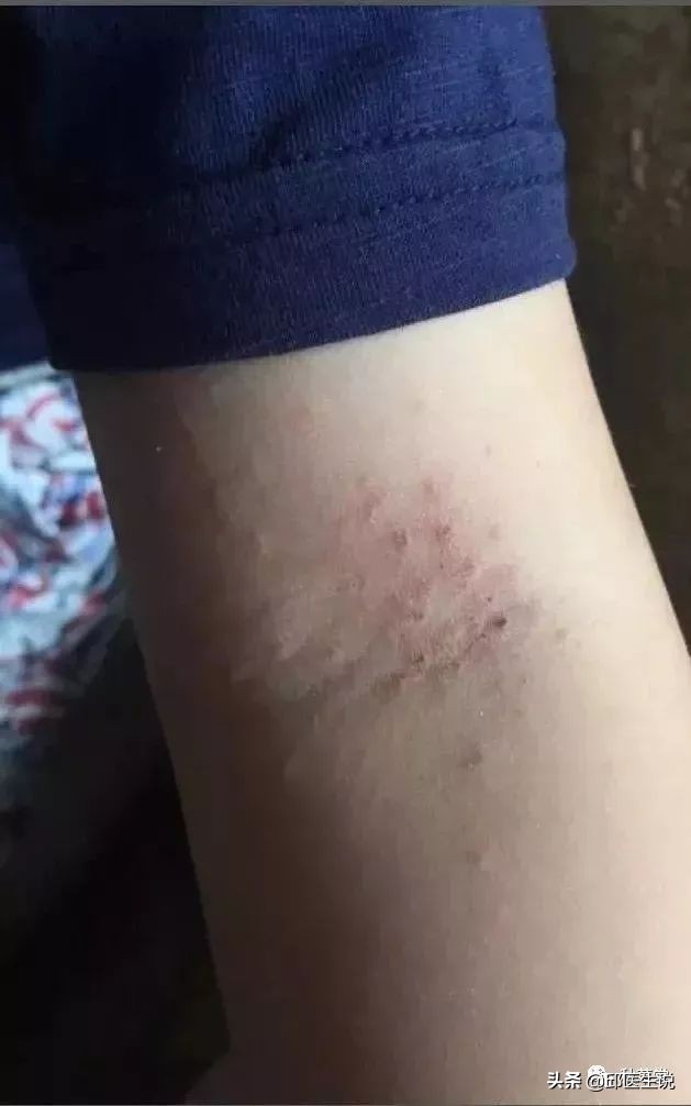 治疗皮肤瘙痒的中医有效便方