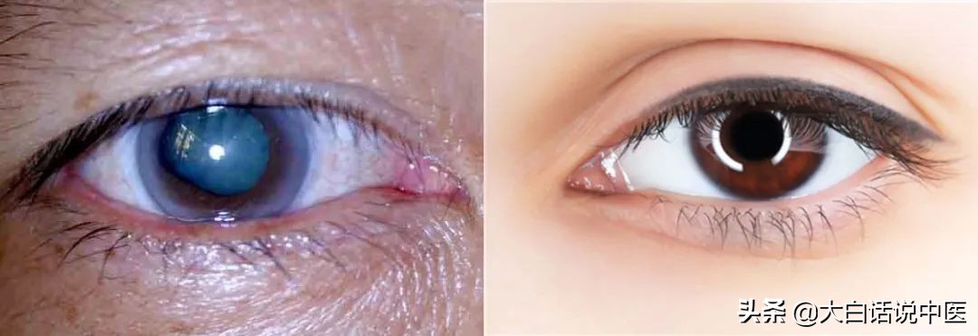 大白话说中医第二十三期｜老年痴呆不用怕，早早预防躲开它