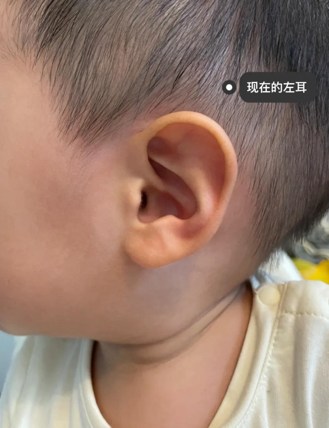 宝宝出生耳廓畸形但是听力正常,刚出生宝宝畸形耳朵图片