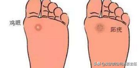 皮肤疣的描述,皮肤疣的中医治疗方法