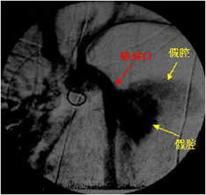 急性心肌梗死的做法,内科主治心肌梗死视频