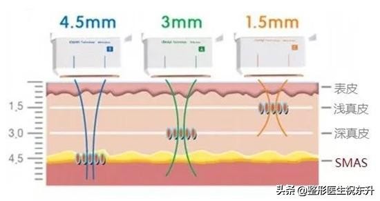 超声刀做了会让脸饱满吗,超声刀做后感触