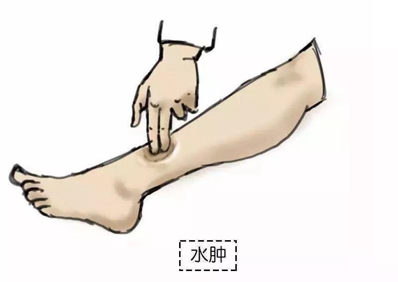 你知道肥胖也分类型吗,心源性水肿和肾性水肿的区别