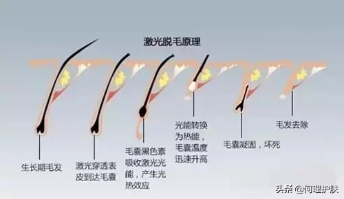 脱毛膏还是激光脱毛比较好,脱毛膏剃须刀