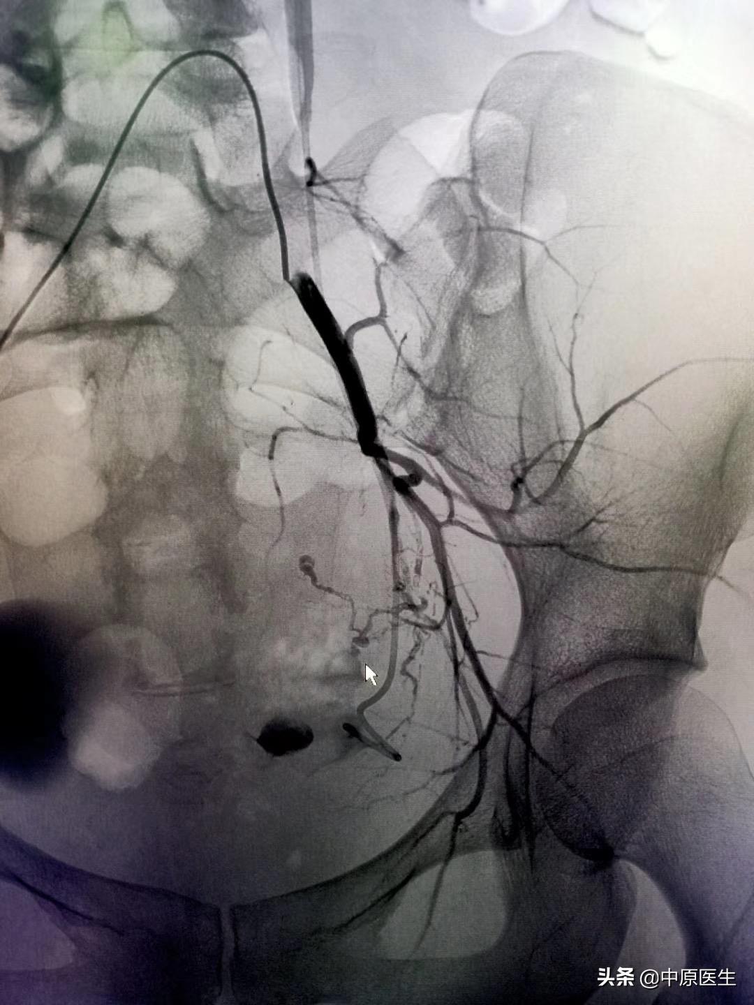 宫颈鳞癌需要切除哪里,宫颈鳞癌出血怎么处理