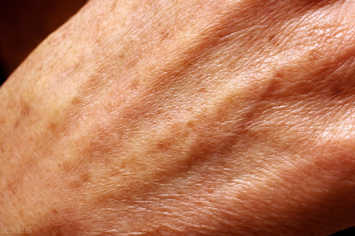 身上老年斑消除最好的方法是什么,长老年斑有什么办法可以去掉