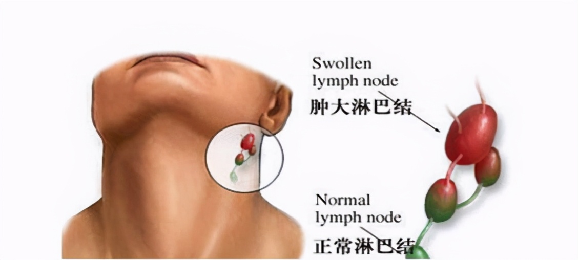 如果肿瘤复发和转移现象如何处理,肿瘤屡次复发应该吃什么药