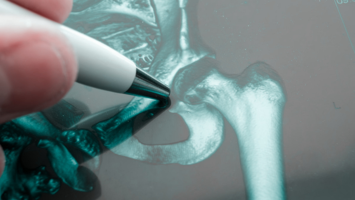 髋关节置换后真的那么容易感染么,骨科关节置换手术注意事项