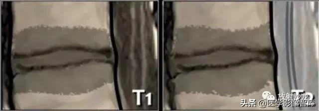 一键收藏所有的内容,颈椎间盘病变的症状和治疗