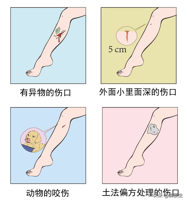 破伤风的感染途径和伤口处理方法,感染了破伤风的伤口会怎样变化