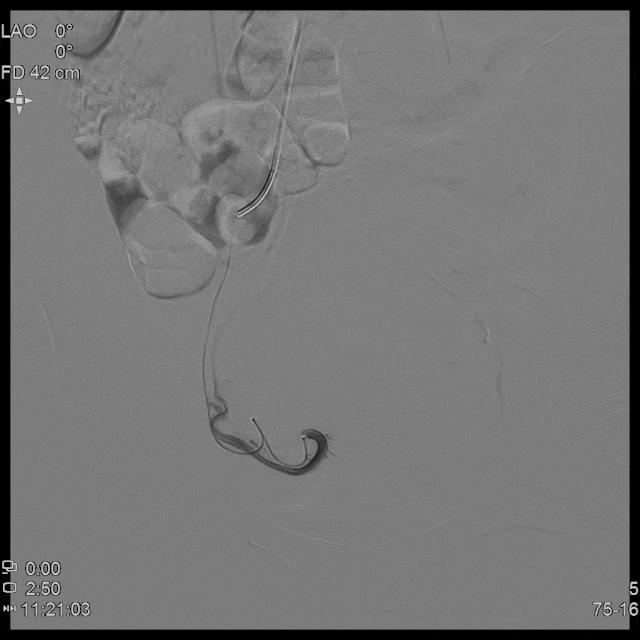 宫外孕保守治疗显示子宫腺肌症,子宫腺肌病保守治疗无效怎么办