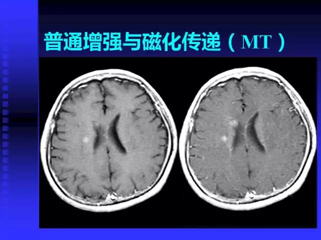 头颅mri读片视频教程,颅脑mri读片入门教程视频讲解全集