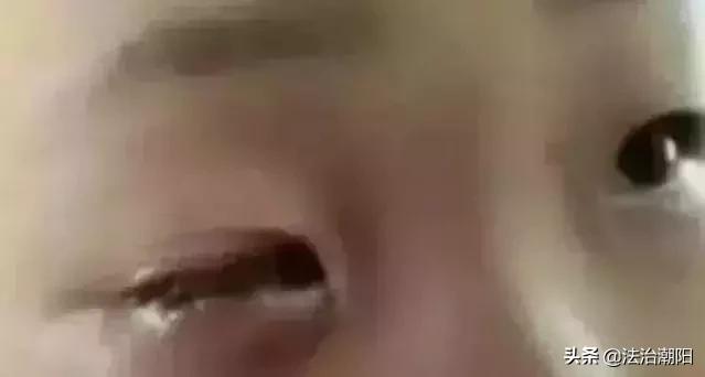 荧光棒弹伤眼睛男孩脱落显失明,男孩眼球被溶化的原因