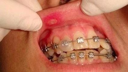 拔牙矫正牙齿后口腔溃疡怎么办,矫正牙齿后经常口腔溃疡怎么办