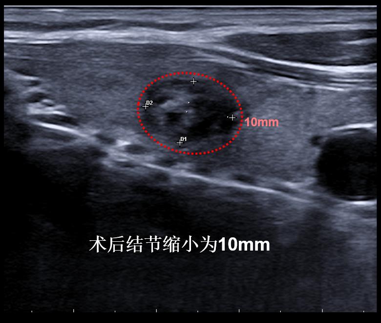 哈尔滨微创消融甲状腺结节哪家好,甲状腺结节微创消融术的过程