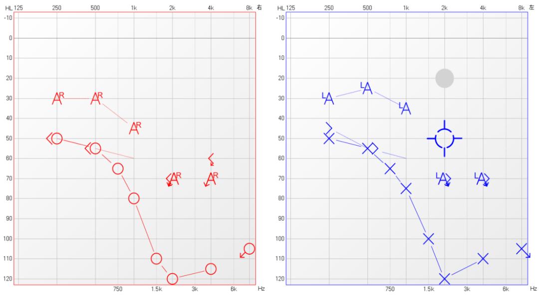 重度耳聋戴小型助听器能听到吗,极重度听力损失带助听器
